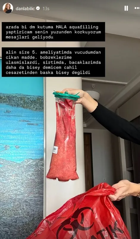 Danla Bilic’ten Şok Paylaşım: “5. ameliyatımda vücudumdan çıkan madde” 3 0x0 5 kez ameliyat olan danla bilic bobregime ulasmislardi 1765264162464